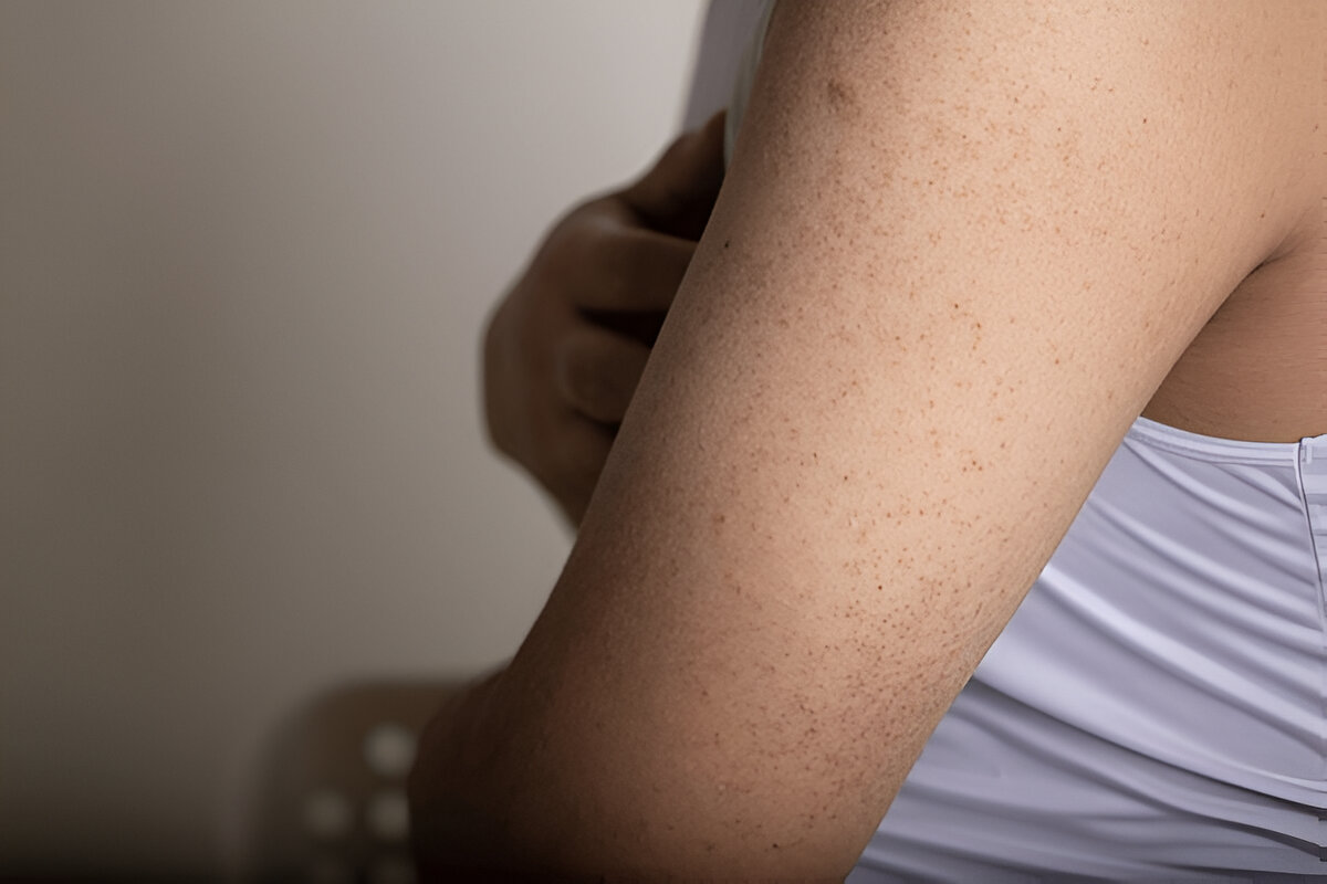Keratosis pilaris or small bumps